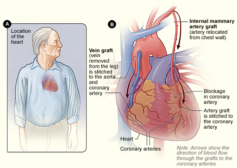 Schema anatomico del bypass aorto-coronarico con graft arterioso e venoso
